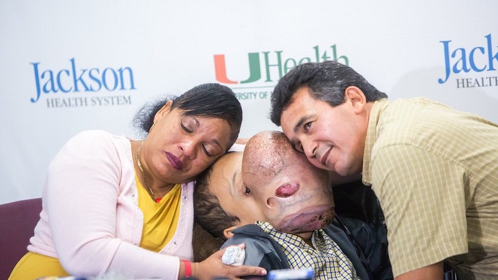 Morre Emanuel, o adolescente cubano que tinha um enorme e raro tumor no rosto, após ser operado nos EUA